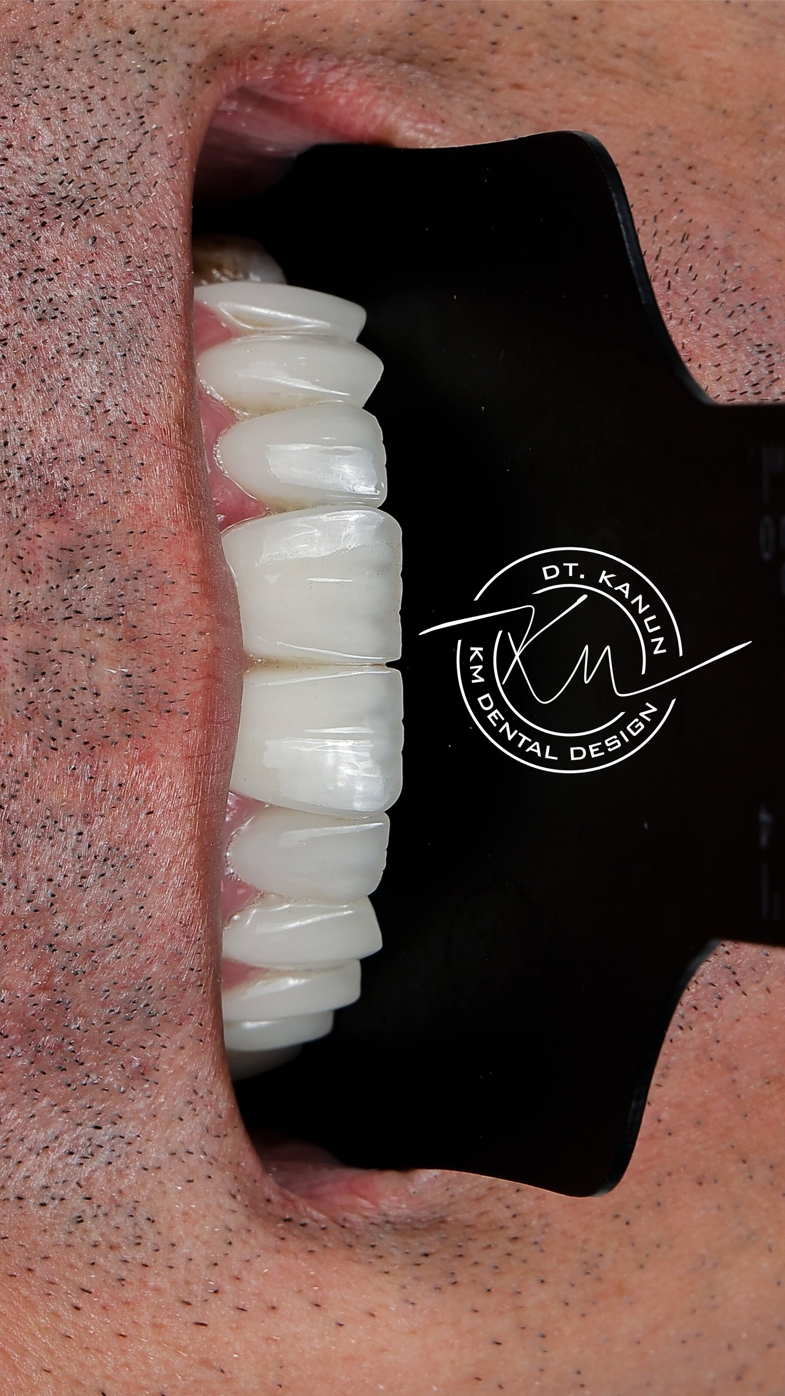 KM Dental Design - Before After 3